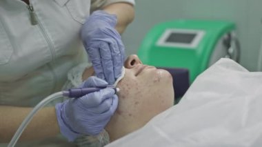 Kozmetik prosedür, operasyon. Doktor sorunlu deriyi sivilcelerle ve sivilcelerle tedavi ediyor. Sağlıklı cilt için lazer