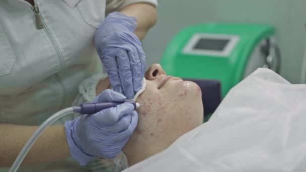 Cosmetologische procedure, operatie. De arts behandelt probleemhuid met puistjes en acne. Laser voor een gezonde huid — Stockvideo