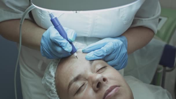 Pacientka u kosmetologa, dermatologa. Vyhlazuje vrásky na čele kryoplazmovou a argonovou koagulační operací — Stock video