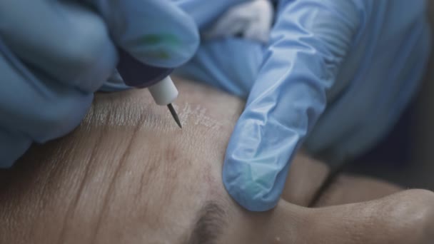 Косметолог робить процедуру мікродермабразії шкіри обличчя реальної жінки — стокове відео