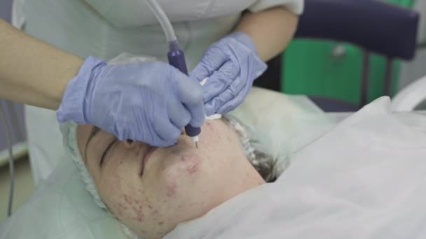 Kosmetický zákrok, operace. Lékař léčí problémovou pleť s pupínky a akné. Laser pro zdravou pokožku — Stock video