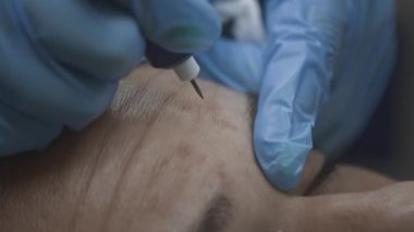 Kozmetik uzmanı bir dermatoloğun resepsiyonundaki kadın hasta. Alnındaki kırışıklıkları kriyoplazma ve argon pıhtılaşma ameliyatıyla düzleştirir.