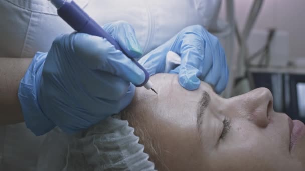 Paziente donna dal medico dermatologo cosmetologo. leviga le rughe della fronte con crioplasma e chirurgia della coagulazione dell'argon — Video Stock