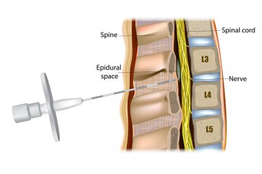 Epidural anestezi ya da epidural anestezi. Tuohy Epidural İğnesi.