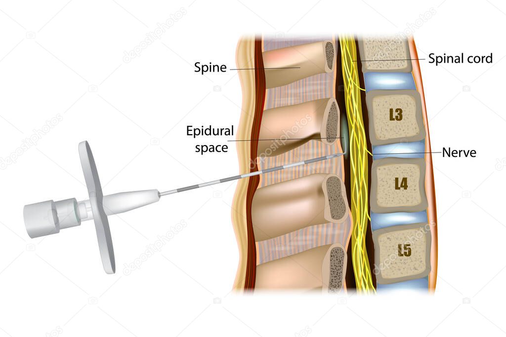 Administración epidural o anestesia epidural. Aguja epidural Tuohy. 2024