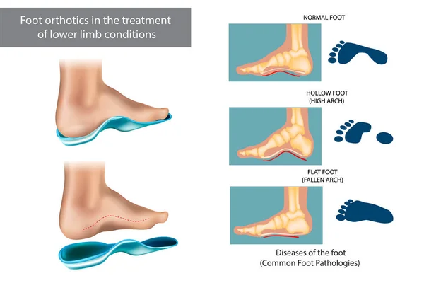Erkrankungen des Fußes. Fußorthesen bei der Behandlung von Erkrankungen der unteren Extremitäten — Stockvektor