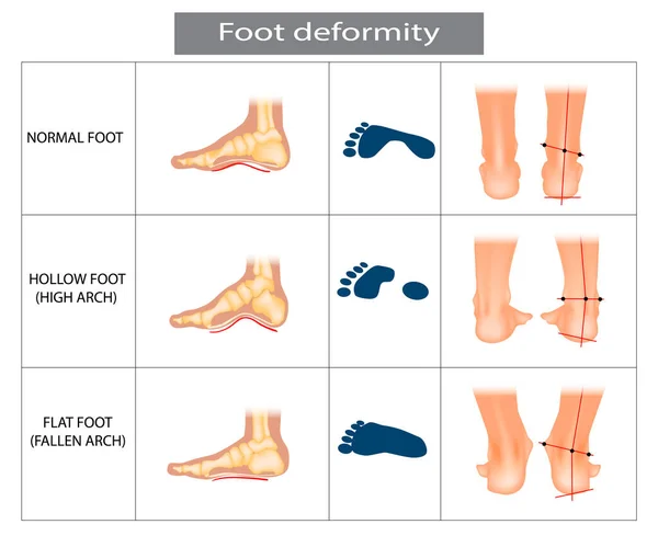 Déformation du pied. Types pathologies du pied. Pied creux, plat et normal. — Image vectorielle