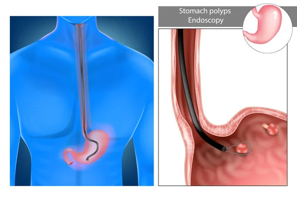 Pólipos gástricos. Estómago Endoscopia superior. — Vector de stock