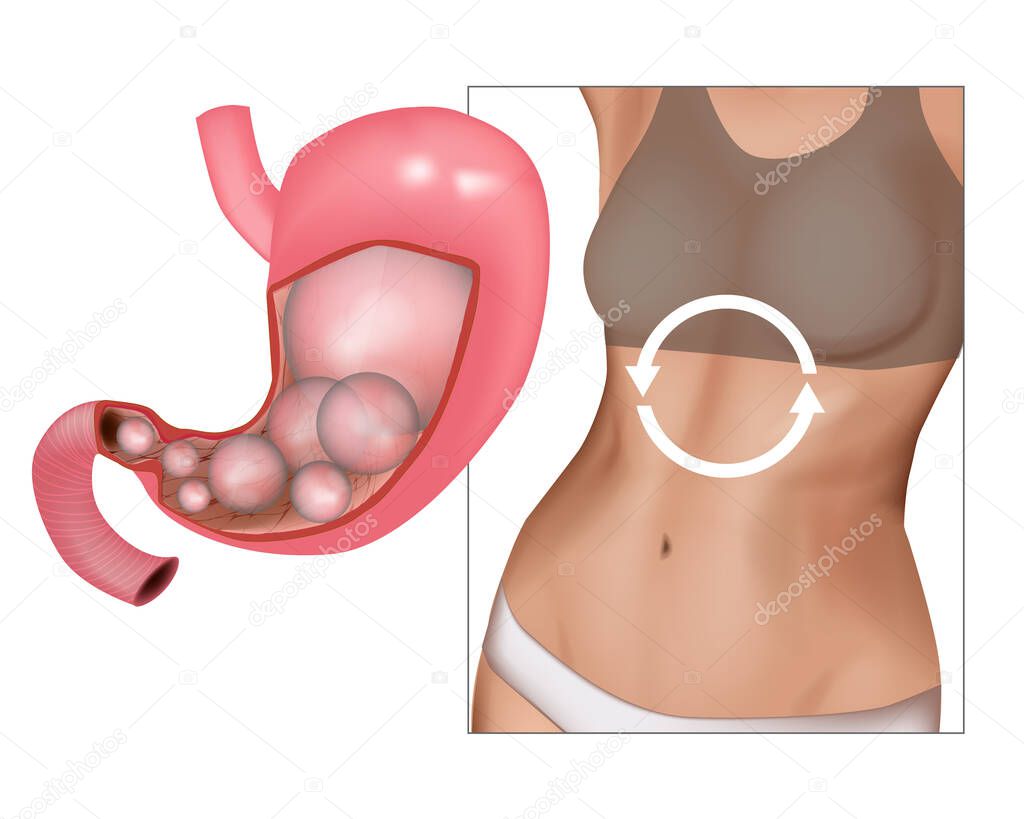 Realistic medical illustration abdominal bloated. Feeling bloated concept, woman having abdominal pain.