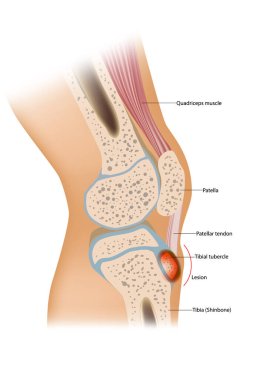 Osgood Schlatter disease or OSD is inflammation of the patellar ligament at the tibial tuberosity clipart
