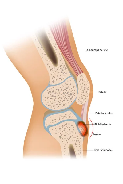 Osgood Schlatter disease or OSD is inflammation of the patellar ligament at the tibial tuberosity — Stock Vector