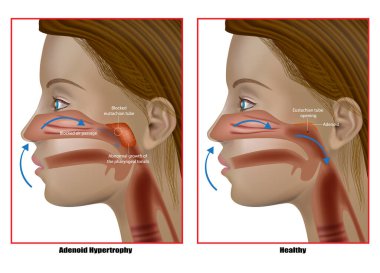 Adenoid hypertrophy, the abnormal growth of the pharyngeal tonsils. Adenoidectomy. Eustachian Tube Dysfunction clipart