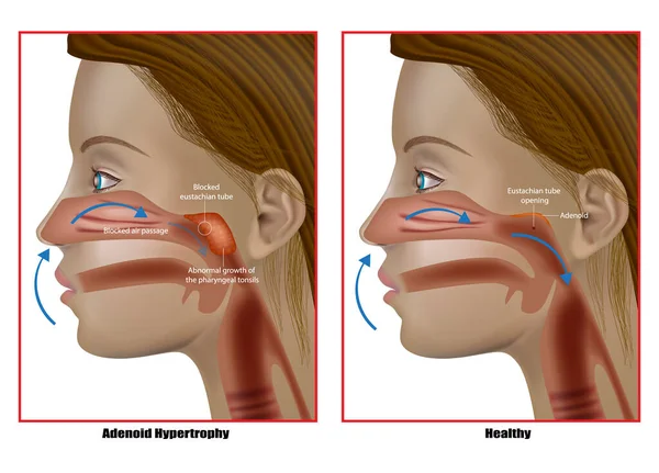 Ipertrofia adenoide, crescita anormale delle tonsille faringee. Adenoidectomia. Disfunzione del tubo di Eustachio — Vettoriale Stock