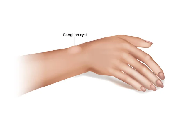 Ganglion Cyst of the Wrist and Hand. Synovial cyst or a Gideon s Disease, or a Bible Cyst, or a Bible Bump. — Stock Vector