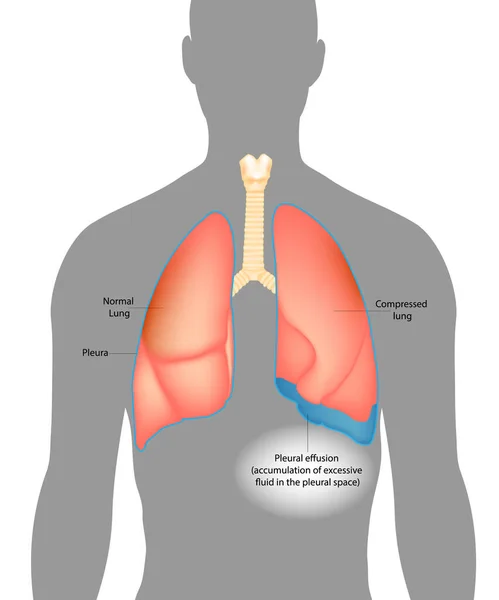 Efusión pleural.Acumulación de líquido excesivo en el espacio pleural. — Archivo Imágenes Vectoriales