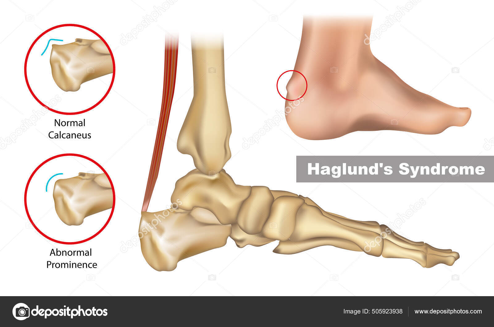 Haglund Disease