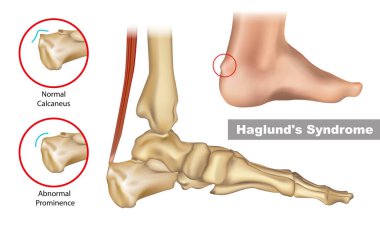 Haglunds deformity is an abnormality of the bone and soft tissues in the foot. An enlargement of the bony section of the heel. clipart