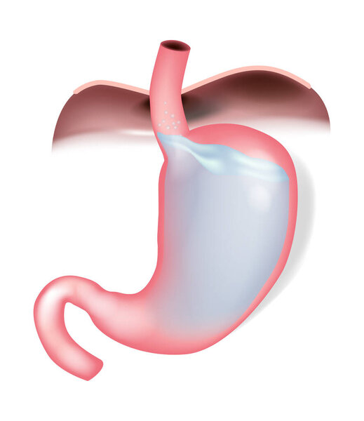 Gastroesophageal reflux disease illustration, acid reflux in stomach and esophagus. Acid reflux anatomy showing stomach contents regurgitation