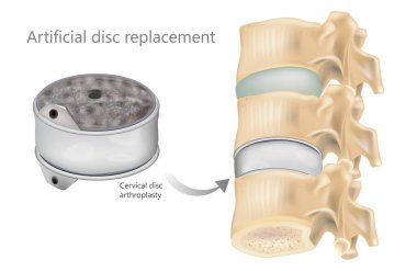 Servikal Yapay Disk Değiştirme Anatomi İllüstrasyonu. Disk eklembacaklısının tıbbi diyagramı. Yapay Omurga Diski Protezi