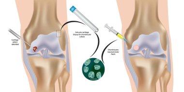 Knee Eklem İllüstrasyonunda Autologous Chondrocyte İmplantasyon Prosedürü. Chondrocyte Kültür ve Enjeksiyon Artiküler Kıkırdak Onarımı. Diz ekleminde ACI prosedürü