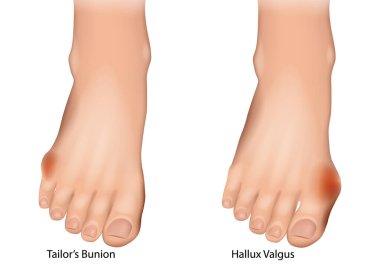 Terzi Bunion Bunionette ve Hallux Valgus Medikal Illustration. Ayak Deformasyonları Karşılaştırması. Bunionette ve Hallux Valgus
