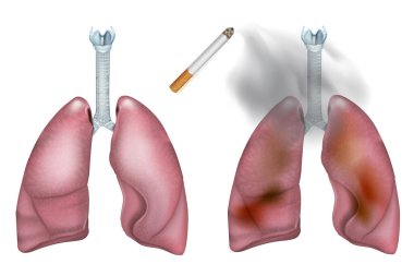 Sağlıklı Akciğerler ve Sigara Hasarlı Akciğerler Karşılaştırmalı Tıbbi Resimler. Sigara İçmenin İnsan Ciğerleri Anatomisi Resimlerinde Etkisi