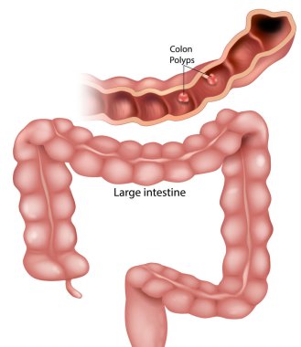 Kalın bağırsak anatomisi, bağırsak duvarında kalın bağırsak polipleri olduğunu gösteriyor. Eğitici sindirim sistemi diyagramı. Gastroenteroloji ve kolorektal hastalık