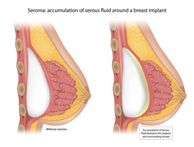 Göğüs implantı etrafında seroma oluşumunu gösteren tıbbi çizimler. Normal göğüs implantı komplikasyonsuz bir şekilde yerleştirilmiş ve dokular ve doku arasında ciddi miktarda sıvı birikmiş..