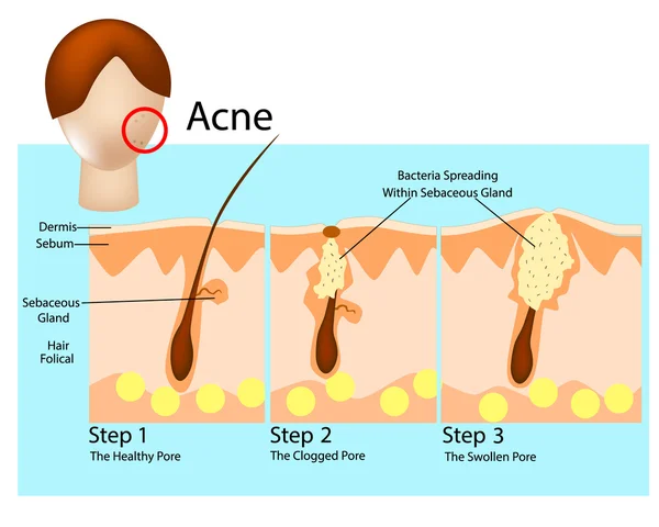 Cómo se desarrolla el acné. Etapas del acné. Formación de acné o espinilla en la piel — Vector de stock