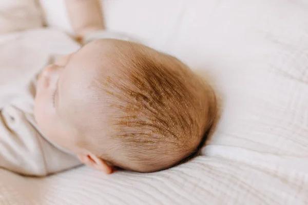 クレードルキャップで赤ちゃんの頭の閉鎖 赤ちゃんの頭皮の乾燥肌 ロイヤリティフリーのストック写真
