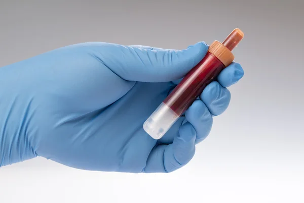 혈액 검사, 혈액 샘플 — 스톡 사진