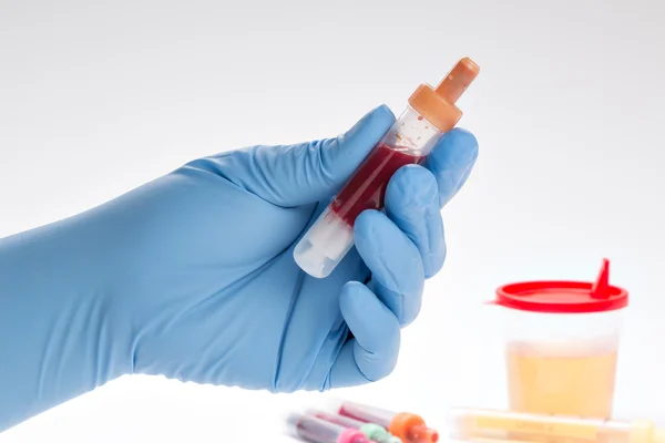 Urine and blood test (complete blood count) — Stock Photo, Image
