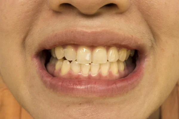 Женщины белые зубы показывая здоровую жвачку — стоковое фото