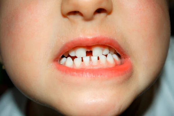 The large spacing between teeth in boys mouth — Stock Photo, Image