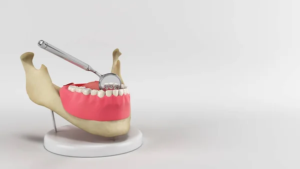 Lingual Braces System Demonstration Denture Render Image — Stock Photo, Image