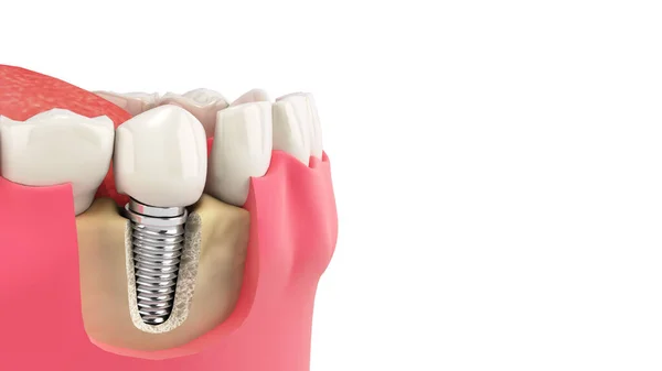 Tooth Human Single Implant Dental Concept Human Teeth Dentures Render — Stock Photo, Image