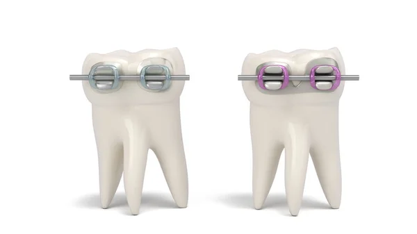 Dental Braces Plastic Metal Base Installed Tooth Render Wite — Stock Photo, Image