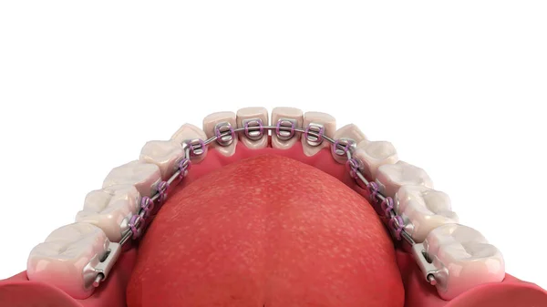 白色示范假牙3D上的语言支撑系统 — 图库照片