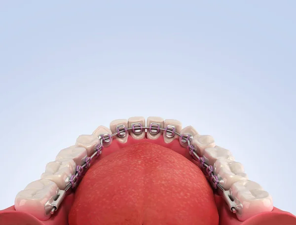 Lingual Braces System Demonstration Denture Color Gradient — Stock Photo, Image