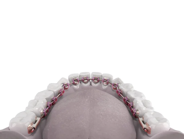 Lingual Braces System Demonstration Denture Color Gradient — Stock Photo, Image