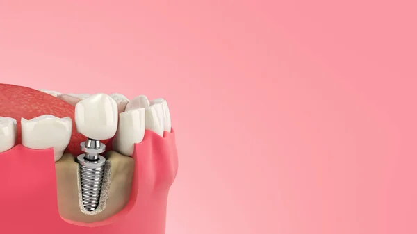 Dente Humano Único Implante Dental Conceito Dentes Humanos Dentaduras Renderizar — Fotografia de Stock