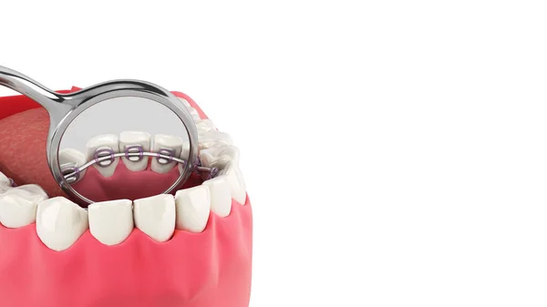 Lingual Braces System Demonstration Denture Close White — Stock Photo, Image