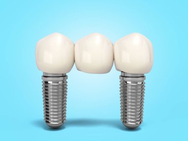 Diş köprüsü, diş implantı. İnsan dişleri ya da takma dişler. Çok dişli 3D renkte.