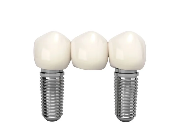 Tooth Human Bridge Implant Dental Concept Human Teeth Dentures Multitooth — Stock Photo, Image