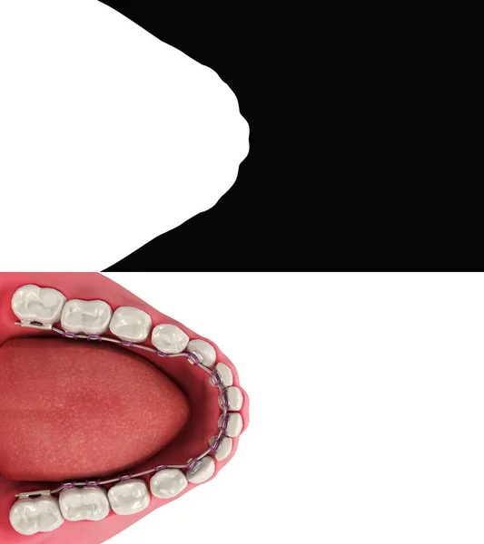 Linguales Zahnspangen System Einer Demonstrationsprothese Auf Wnite Alpha Beinhalten — Stockfoto