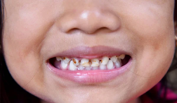 4歳の子供が彼女の歯を近くで見せて ストック写真