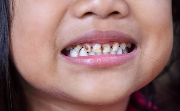 Four Years Old Kid Showing Her Tooths Close Stok Gambar