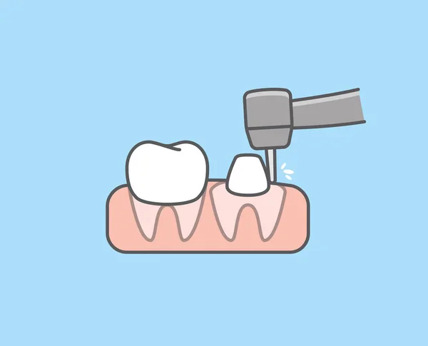 White Tooth Trimmed Handpiece Dental Instrument Prepare Crown Tooth Illustration — 图库矢量图片