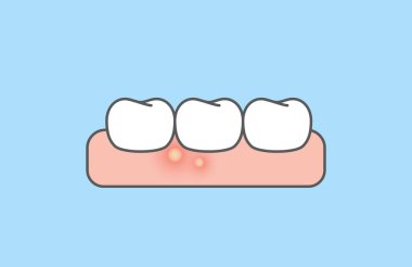 The gumboil and white teeth. illustration vector design on blue background. Dental care concept. clipart