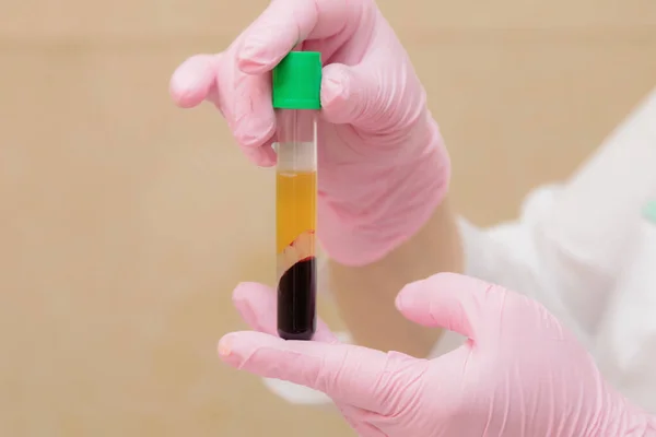 Bir uzmanın elinde kan plazması olan bir test tüpü. Plazma kaldırıcı